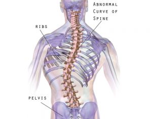 Scoliosis 300x234
