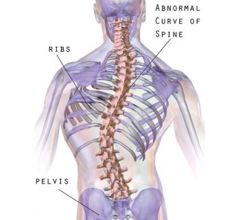 Scoliosis 360x320