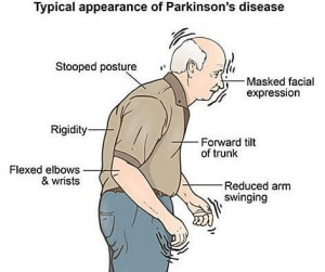 Parkingson 300x251