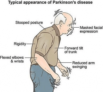 Parkingson 360x320
